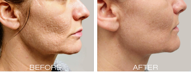 before and after skin treatment