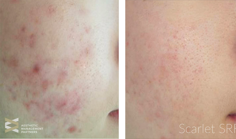 before & after skin treatment