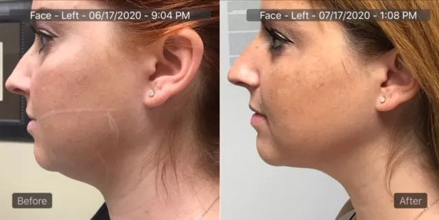 Before & After Microneedling