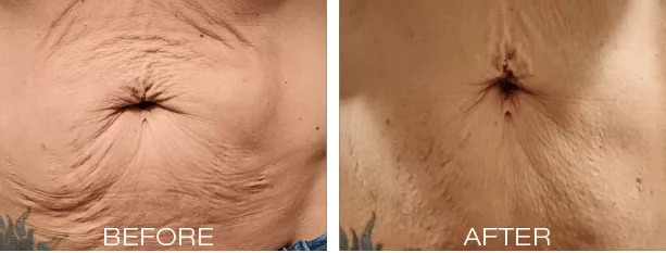 before & after SRF Microneedling