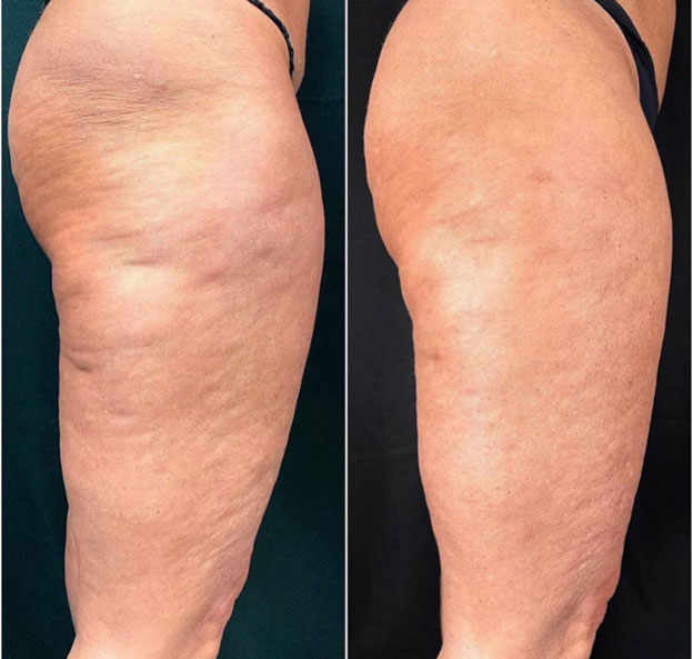 before & after images of leg